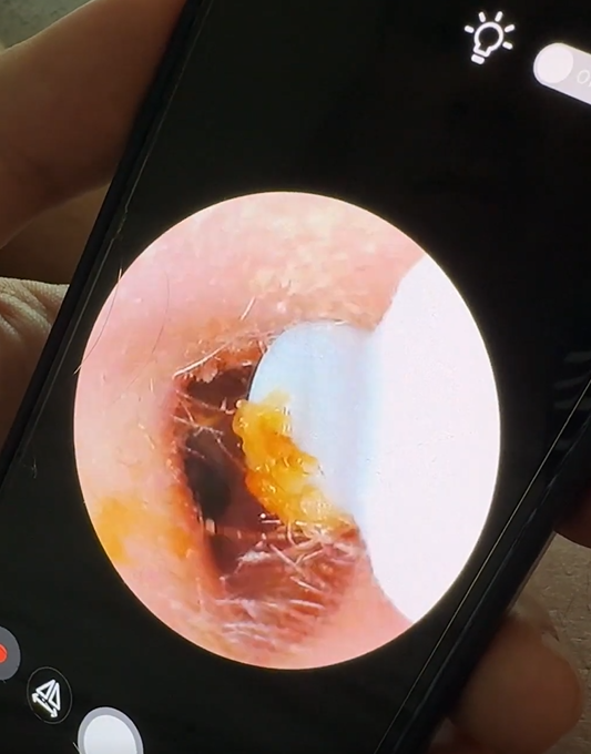 Kit d’élimination cérumen à caméra